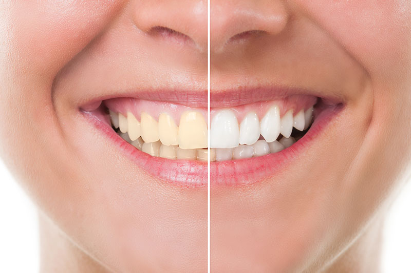 Teeth Whitening - Aurora and West Chicago Dental Care, Aurora Dentist